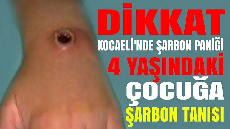 4 yaşındaki çocuğa şarbon tanısı koyuldu!